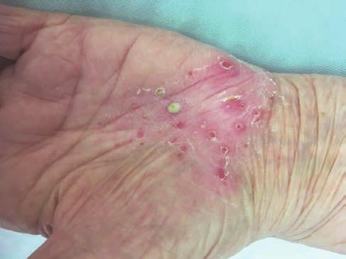 Pikkelysömör (pszoriázis, psoriasis) tünetei és kezelése - HáziPatika