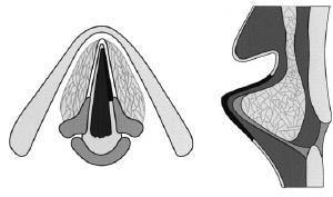 Type I chordectomia subepithelialis (epithel + Reinke-tér) ha egész hsz.