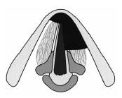 Type V chordectomia Va lig. conicumra, subglottisra kiterjesztve - lymph. drainage!