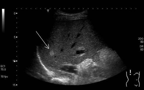 A JÓINDULATÚ MÁJDAGANATOK KEZELÉSE 7 Képalkotó vizsgálatok után is fennálló diagnosztikai bizonytalanság esetén perkután szövettani mintavétel elvégezhető, amennyiben a májtumor és májtok között ép