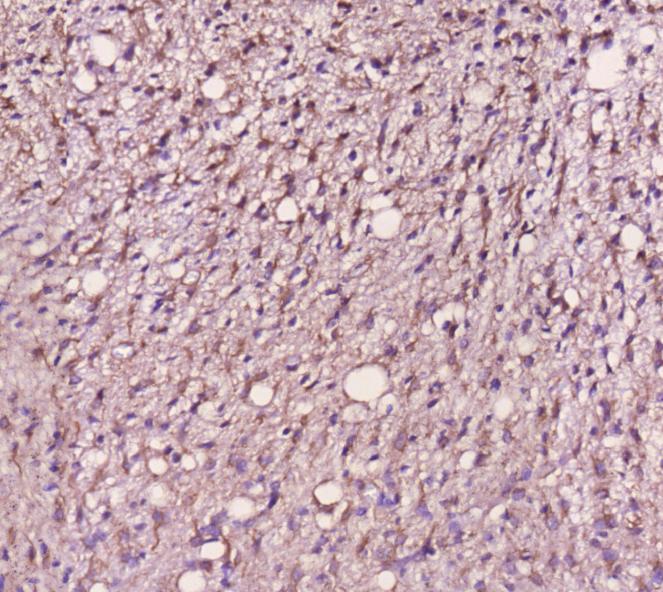 (3.Táblázat). Ezt a tesztet technikai pozitív kontrollként használtuk, hiszen a glioblastoma tipikusan GFAP pozitív (bár néha előrehaladott stádiumban elveszítheti a GFAP festődést a tumor).
