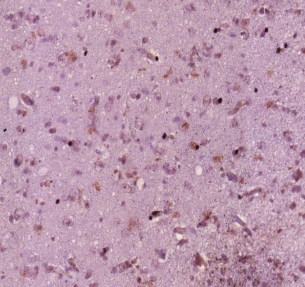 Ábra - NF-1 nukleáris és citoplazmás festődés 11424/05 A műtéti minta 6a és a post mortem minta 6b összevetése során látható anti-neurofibromin IHC mindkét esetben pozitív jelet adott.