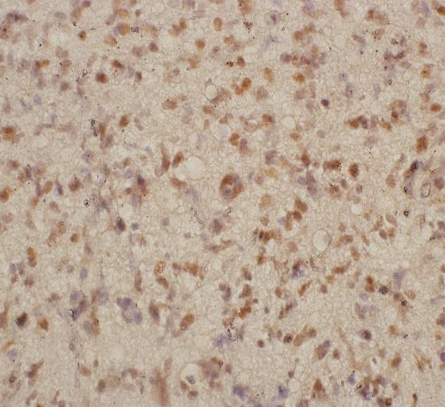 A mutáció specifikus anti-idh-1 R132H monoklonalis egér antitest (DIA-H09 Dianova GmbH, Hamburg, Németország) (3.Táblázat) festődési mintázatára citoplazmatikus festődés jellemző.