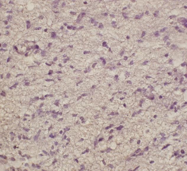 Ábra 11424/05 CD133 IHC A 12-es a és b Ábra mindegyike negatív eredményt adott CD133 markerre.
