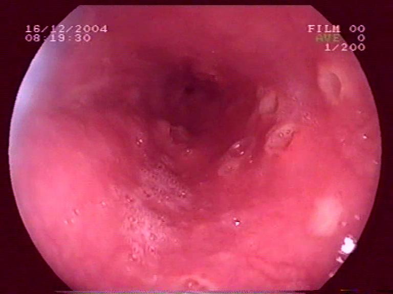 24 Fig. 13. Esophageal manifestation of Crohn s disease. Fig. 14. Esophageal manifestation of Crohn s disease after indigo carmine staining 3.4. Endoscopic mucosal resection 3.4.1. Endoscopic mucosal resection of flat lesions 56 gastric polyps in 44 patients met the inclusion criteria.