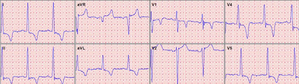 EKG-k az