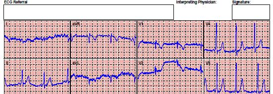 TTEKG - 9 éves leány WPW syndroma