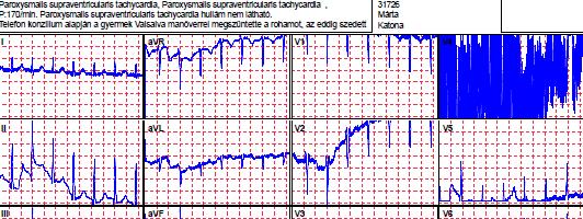 TTEKG- 12 éves fiú WPW syndromával