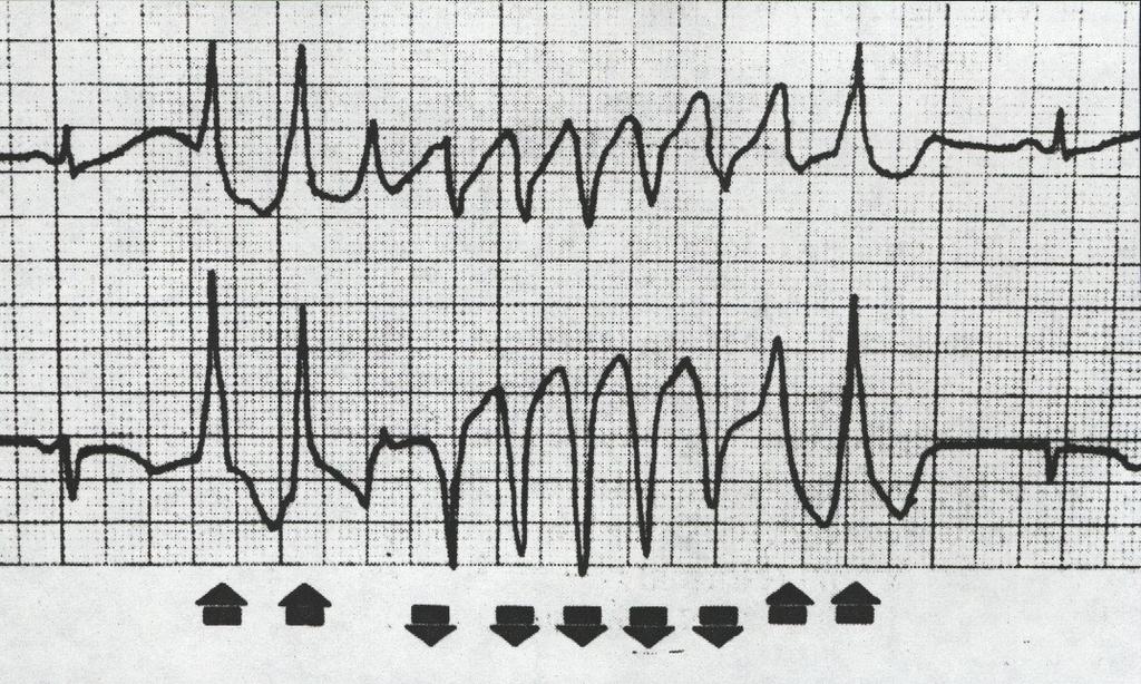 Művelődés-, Tudomány- és Orvostörténeti Folyóirat 2012Vol3No5 DOI:1017107/KH2012526-74 paroxysmalis kamrai flatternek/vf-nek, transient ventricular fibrillation-nek, fibrillation ventriculaire