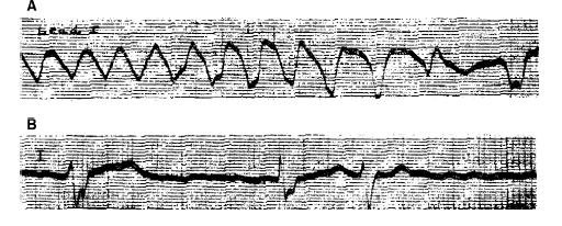 Művelődés-, Tudomány- és Orvostörténeti Folyóirat 2012Vol3No5 DOI:1017107/KH2012526-74 3 ábra A legelső EKG-val dokumentált, visszatérő Adams Stokes-szindrómát előidéző kaotikus ventricularis