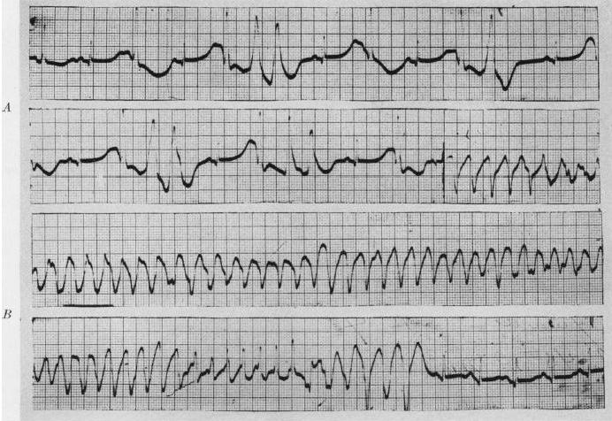 Művelődés-, Tudomány- és Orvostörténeti Folyóirat 2012Vol3No5 DOI:1017107/KH2012526-74 tachycardia, a prefibrillatory or flutter-type of ventricular tachycardia, and ventricular fibrillation ),