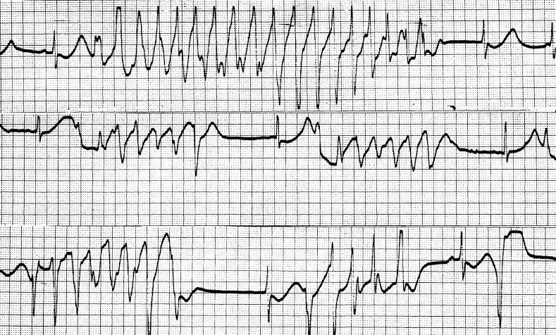 Művelődés-, Tudomány- és Orvostörténeti Folyóirat 2012Vol3No5 DOI:1017107/KH2012526-74 proarrhythmiás (torsadogen) hatását és kétségbevonhatatlanul bizonyítja az Morgagni Adams Stokes-rohamok és a