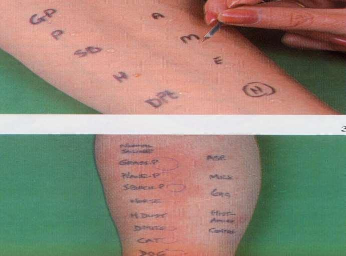 Immediate type allergic