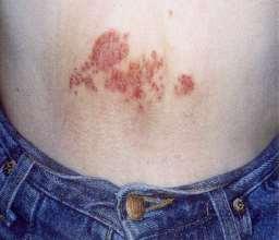dermatitisz IV.
