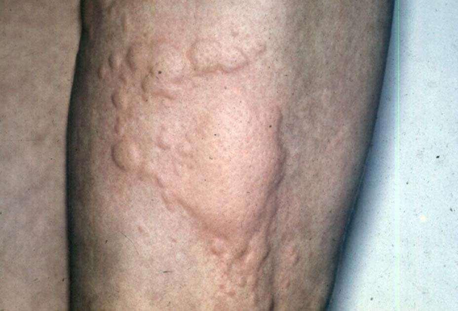 Urticaria