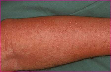 Akut generalizált exanthematosus pustulosis (AGEP) (IV.