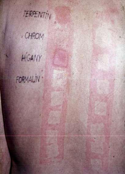 +?: enyhe erythema (kétes) +: erythema, ödéma, infiltráció ++: papula, vesicula is