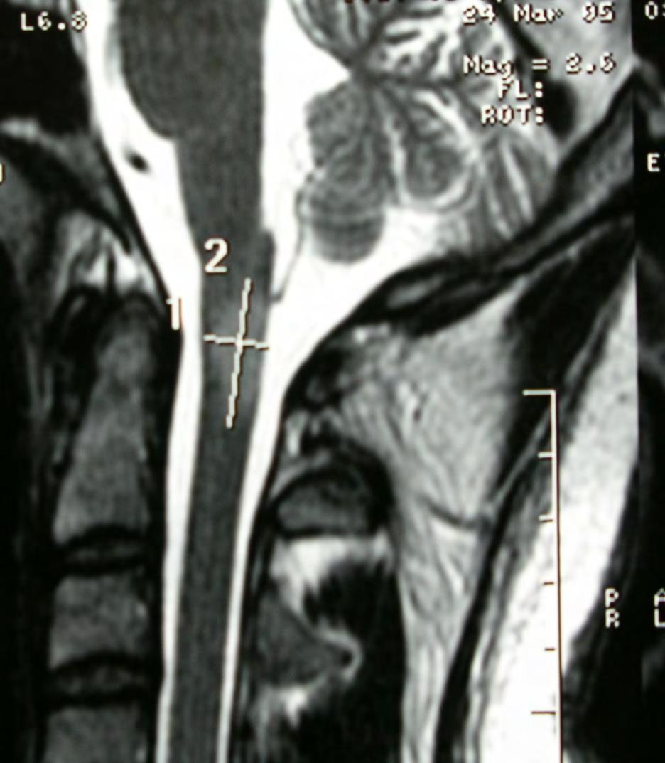 nagyobb T2, T1 Átmérő 3 mm < 2 szegmentum A