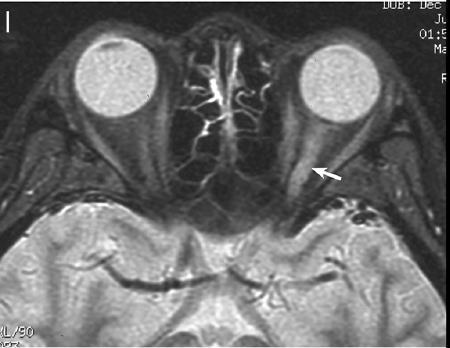 Opticus neuritis 1 v.