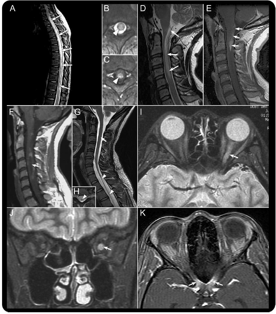 LETM 3 csigolya, folytonos laesio (T2 hyperintens, T1 Gad halmozás), centrális lokalizáció, oedema, cervicalis laesio beterjed az agytörzsbe Rövidebb laesio is lehet: korai /