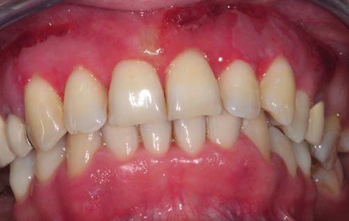 közötti időben a gingiva hámja teljesen megerősödött, a keratinizáció befejeződött, amit napi kétszeri 1%-os cinkklorid oldatos ecseteléssel is siettettük (9. ábra a, b, c, d).
