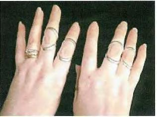 A V-splint