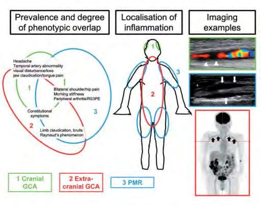 GCA tünetegyüttesek (alcsoportok) Craniális tünetek: arteritis temporalis Nagyér manifesztációk: aorta, (felső) végtagi artériák Szisztémás tünetek: láz, fogyás, étvágytalanság,