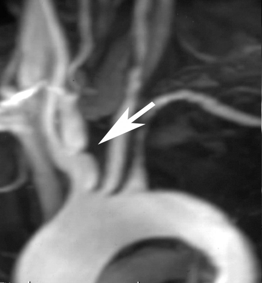 Takayasu-arteritis (ACR,1990) 3/6 1. Betegségkezdet 40 éves kor alatt 2. Végtag-claudicatio (főként felső végtagi) 3. A. brachialis occlusio 4. >10 Hgmm syst RR különbség a karok között 5. A. subclaviák v.