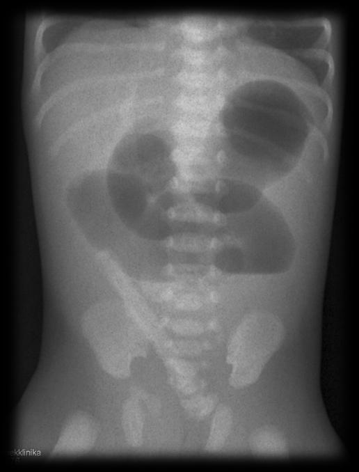 ileus