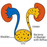 VESICOURETERALIS REFLUX A vesicoureteralis reflux (VUR) detektálása az egyik leggyakoribb vizsgálat a gyermekradiológiában Módszerek: - Mictios