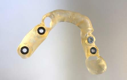 D. Fogászati nyomtatás A fogászati nyomtatással kapcsolatban három különböző alapanyagtípus is elérhető a Formlabs SLAnyomtatókhoz.