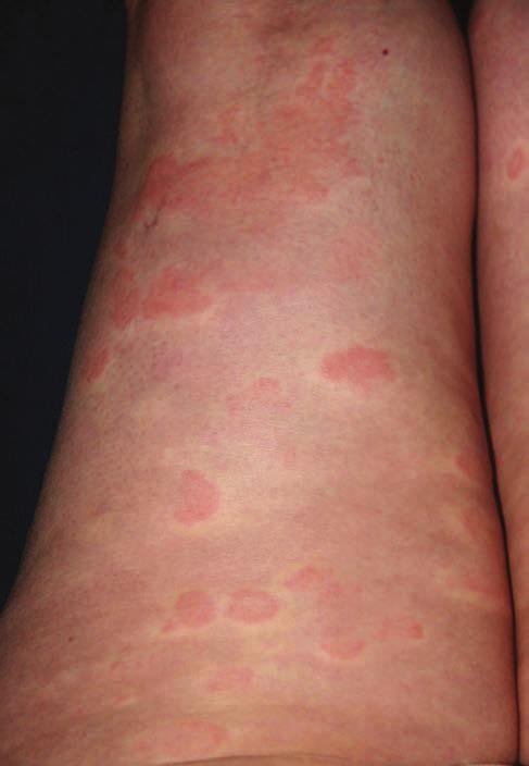 ábra Klinikai kép az urticariform, recidív bőrtünetekről tuk, ahol hat alkalommal szisztémás cyclophosphamide (1000