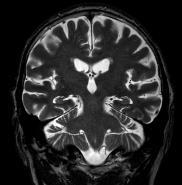 Az orbiták, a sella, a labyrinthus rendszer, a pontocerebellaris régió és a craniospinális átmenet eltérés