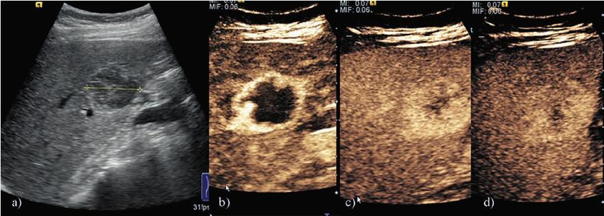 CEUS: máj haemangioma