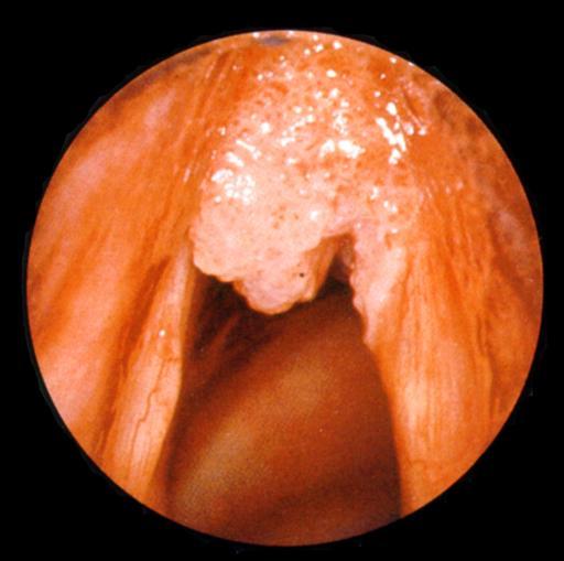 Hangszalagrák Sebészi kezelés: Endolaryngealis laser-chordectomia T1a