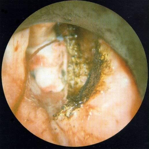 Resectio frontolateralis (Leroux Robert) T1b Resectio frontoanterior (Leroux