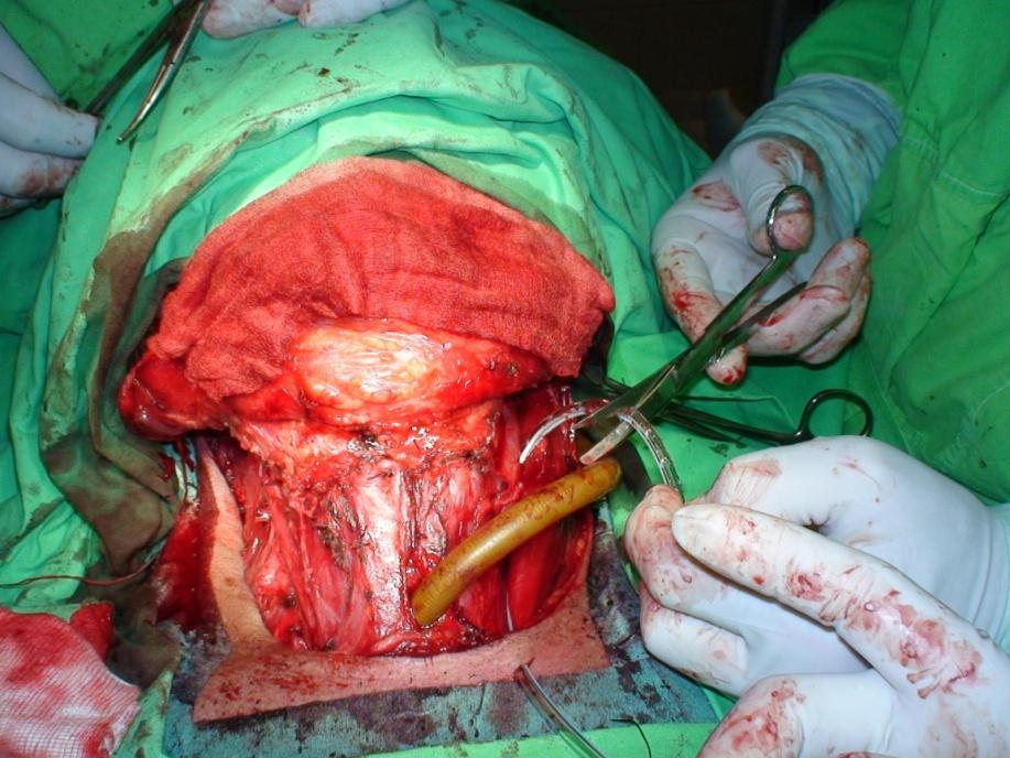 laryngectomy +