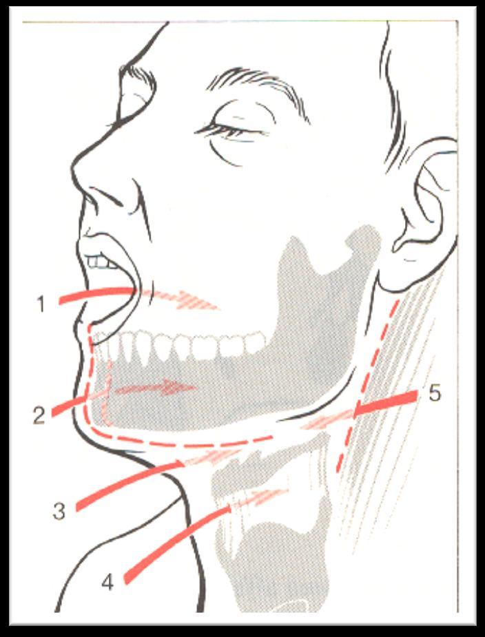 Behatolási irányok a száj és garat daganatok műtéteinél 1. Transoralis 2. Átmeneti mandibulotomia 3.