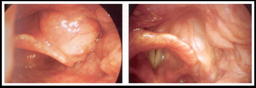 Nyelvgyöki carcinoma