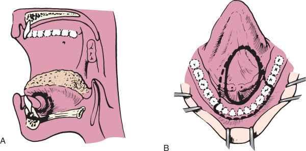 Elülső szájfenéki tumor rezekció A A marginalis