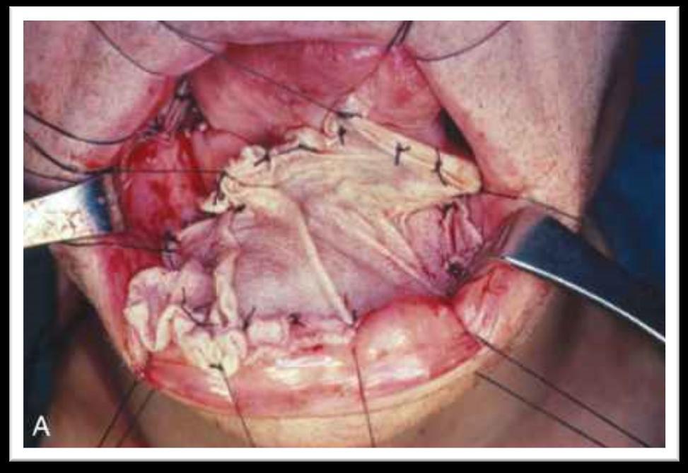 Elülső szájfenéki tumor rezekció és