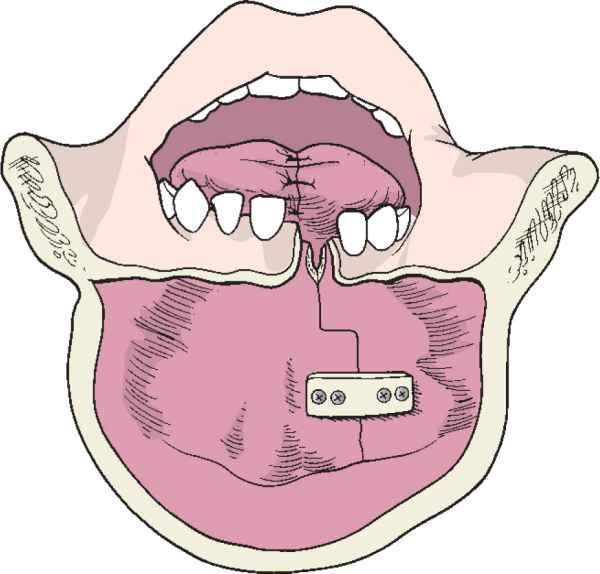 Ideiglenes mandibulotomia IV.