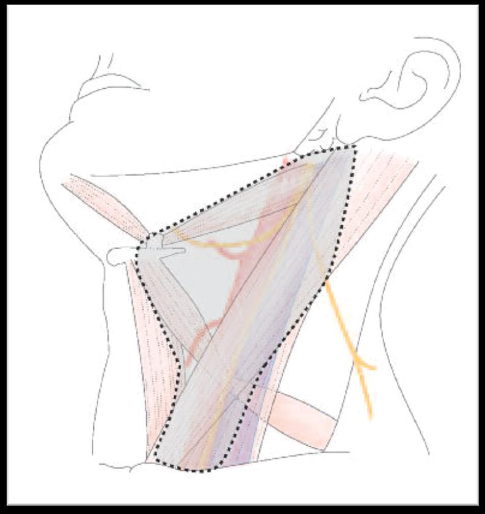 Szelektív nyaki dissectió Szelektív I-II-III régiók (supraomohyoid dissectió) oralis
