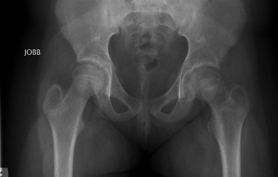 EPIPHYSEOLYSIS CAPITIS FEMORIS A növekedési zóna törése a femur