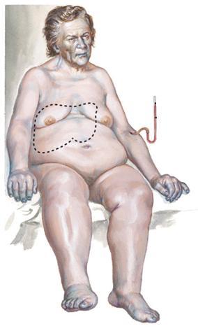 A pangásos szívelégtelenség pathomechanizmusa Pangásos szívelégtelenség Pulmonális hypertenzió Pulmonális betegségek Jobb szívfél-elégtelenség Cardiomyopáthiák