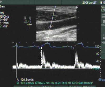 PWV EKG kapuzott pulzatilis