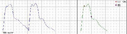 Az eredő pulzushullám görbe oszcillometriás mérése AIx: 6,44 % ED: 305 ms PWV: 9,79 ± 0,7 m/s