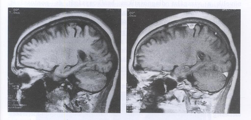 2. Kontrasztanyagok alkalmazása: T1 és T2-kontraszt T1 súlyozott kép meningeoma diagnosztizálásához Gadolinium kontraszt kiemeli a daganat