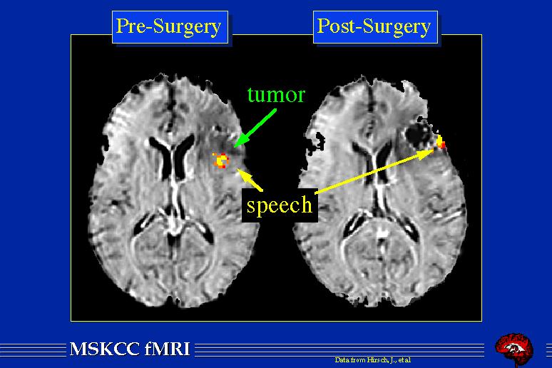 fmri sebészeti területek és