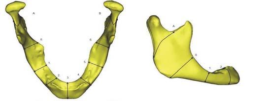 EGYEDI TEHERVISEL ÁLLKAPOCS IMPLANTÁTUM OPTIMALIZÁLÁSÁNAK LEHET SÉGEI 2. RÉSZ OPTIMALIZATION POSSIBILITIES OF PATIENT SPECIFIC LOAD-BEARING MANDIBLE IMPLANT PART 2 Dr.
